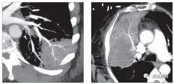 胸部影像诊断图例丨平片及CT征象
