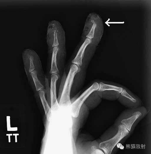 【急诊】腕关节及手平片--临床影像示例