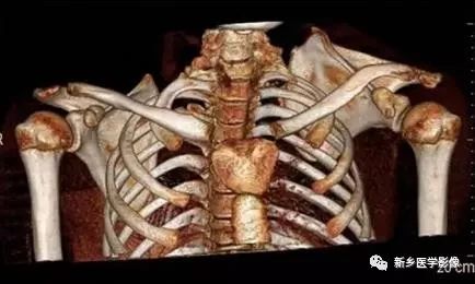 10种脊柱畸形影像表现汇总！