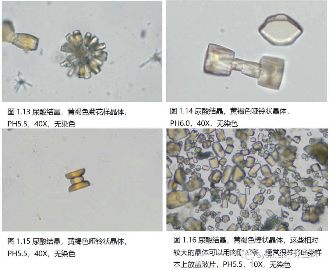 图3-5-56 非晶型磷酸盐结晶-尿液沉渣实录-医学