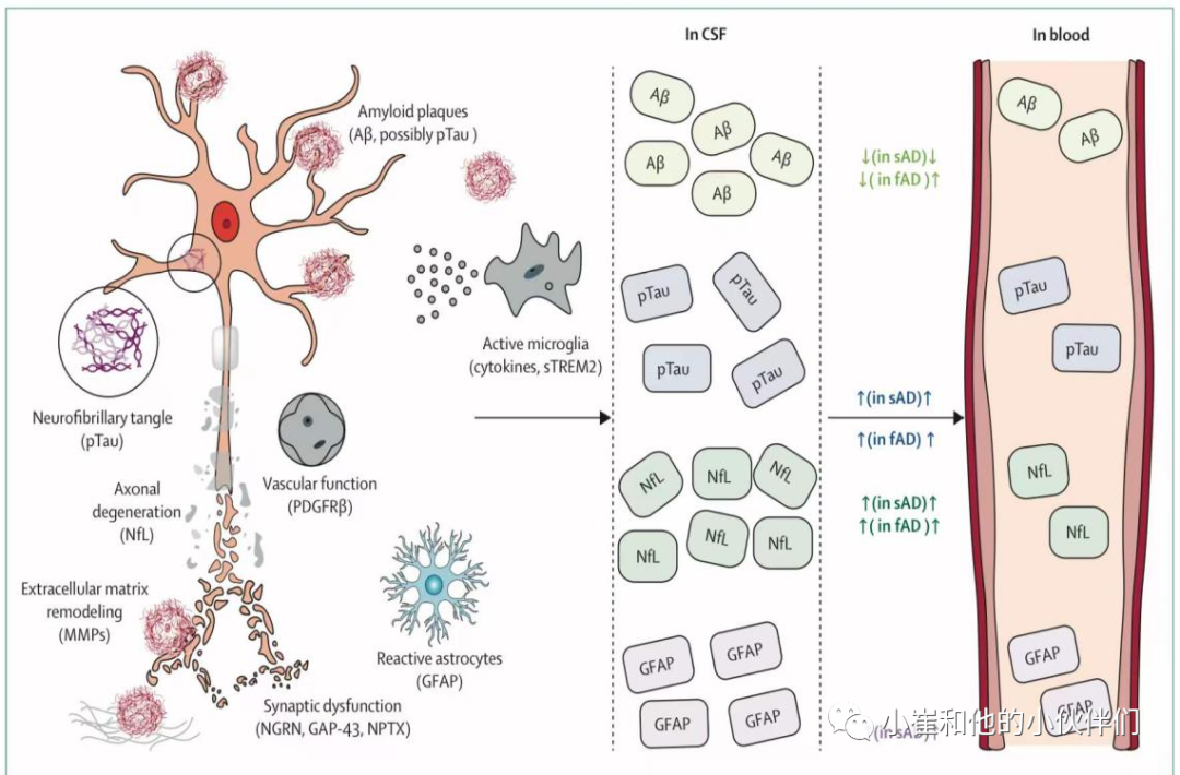 Lancet Neurol：阿尔茨海默病的血液生物标志物：走向临床应用