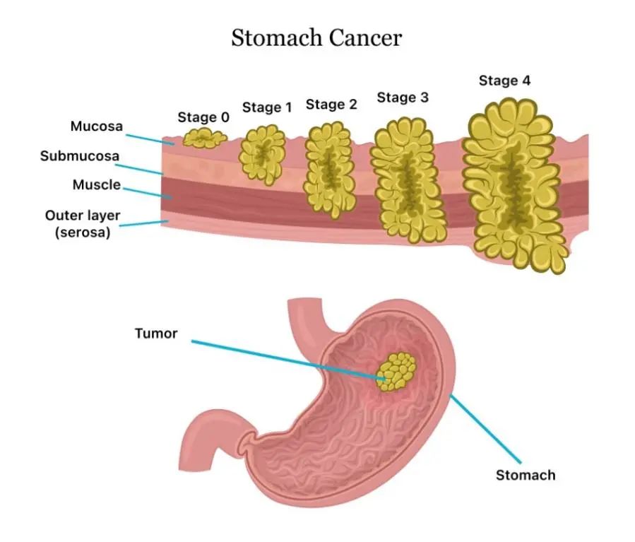 胃癌类器官模型精选