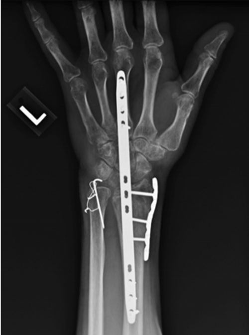 桡骨远端骨折与急性下尺桡关节（DRUJ）损伤