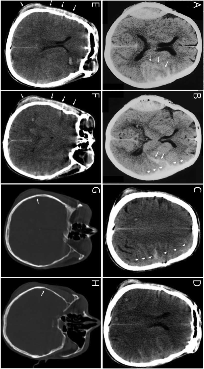 Neurology：消失的硬膜外<font color="red">血肿</font>