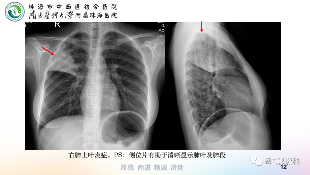 多图一文看懂大叶性肺炎的影像表现