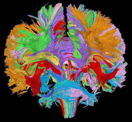 NeuroImage：纤维球成像可用于跟踪<font color="red">癫痫</font>疾病进展