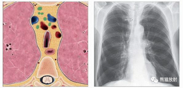 胸部影像诊断图例丨刀鞘样气管、气管狭窄、气管支气管软化症~