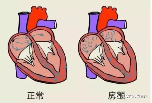 心房颤动与扑动心电图诊断要点