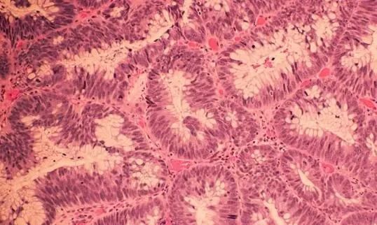 Cancer Discov：科学家识别出与结直肠癌发生相关的特殊细菌蛋白