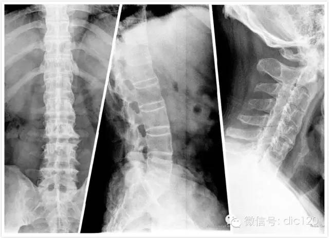 强直性脊柱炎中期图片图片