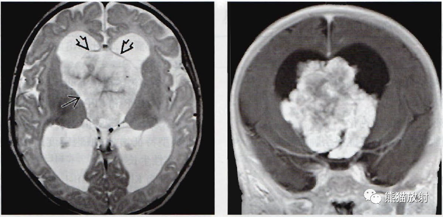 脉络丛乳头状瘤影像图片