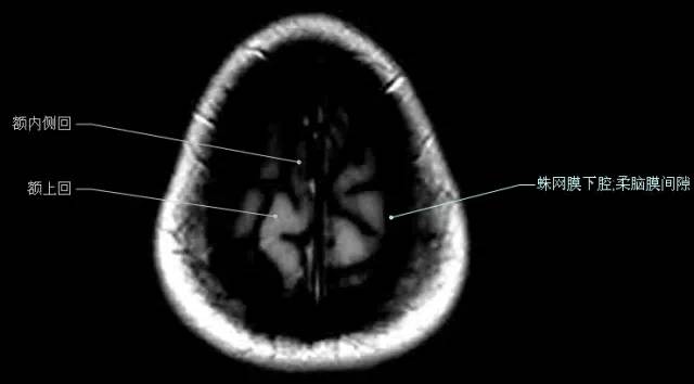 MRI入门丨头颅MR轴位解剖图（彩色标注版）