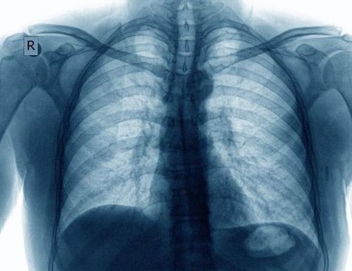 Radiology：动态胸片可用来评估囊性纤维化急性加重治疗效果