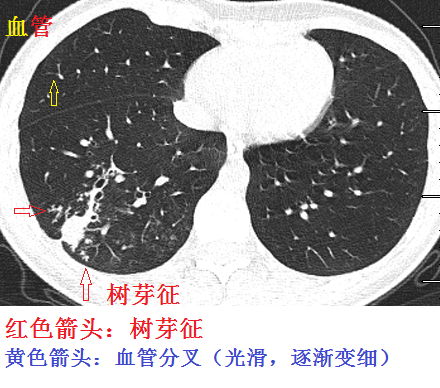 肺部CT基础读片：认识树芽征