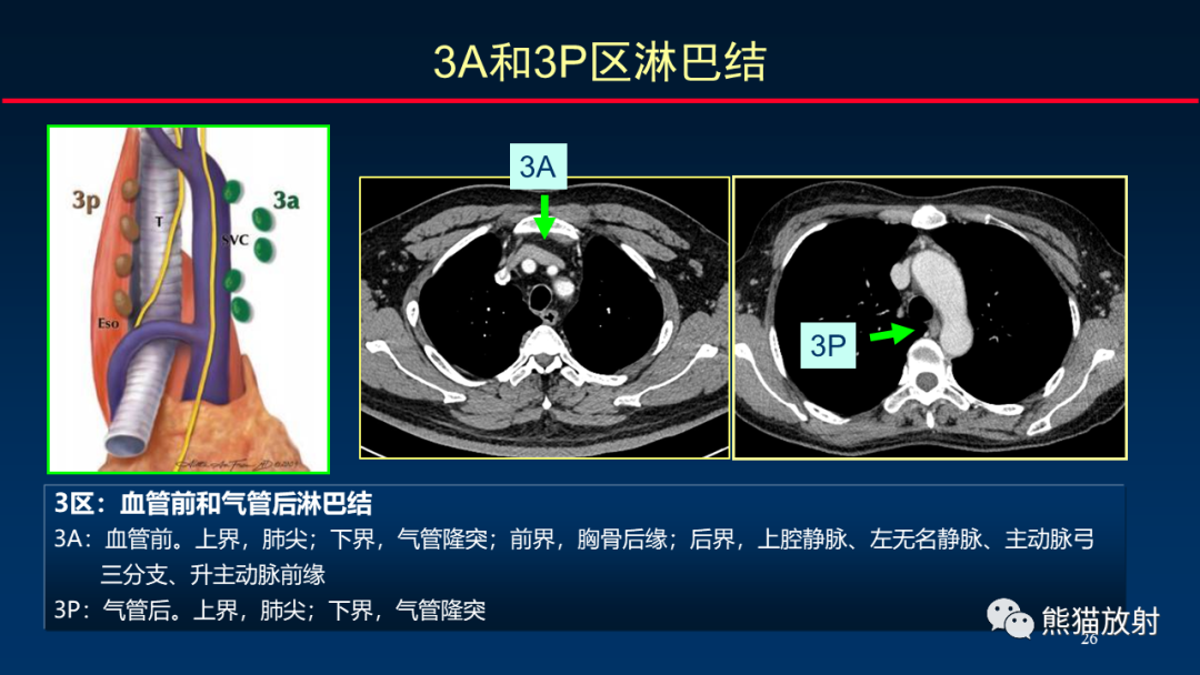 結腫大的判斷(二)淋巴結分區與腫瘤n分期(一)縱隔腫大淋巴結的標準三