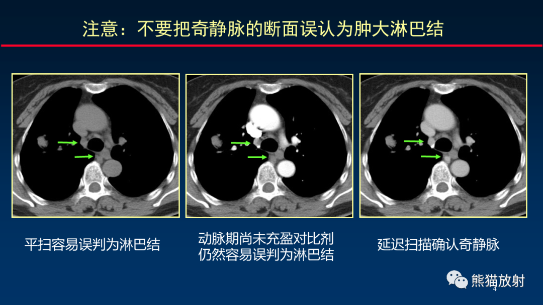 結腫大的判斷(二)淋巴結分區與腫瘤n分期(一)縱隔腫大淋巴結的標準三