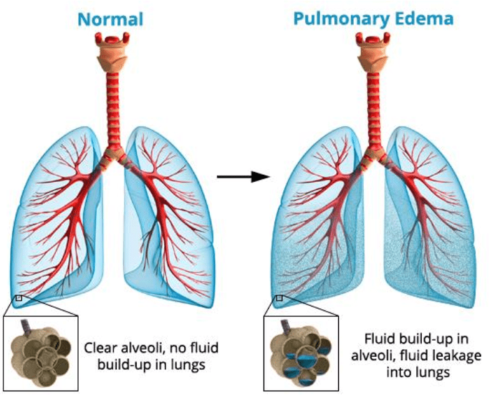 大咖处理心源性急性肺水肿重点关注的10个问题