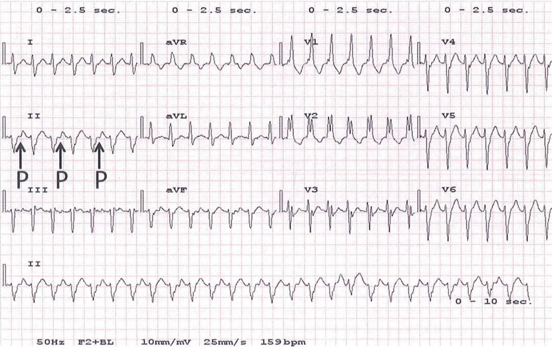病例 | 1例室速患者的心电图特征