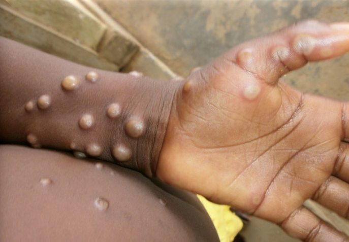 中国猴痘诊疗指南发布：对症支持治疗，人际间可通过飞沫传播
