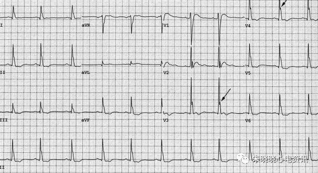 有图有真相70多个导致t波及st段异常的原因