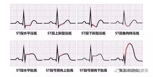 特異性的st段異常包括st段抬高型心肌梗死(stemi),心包炎或心肌缺血