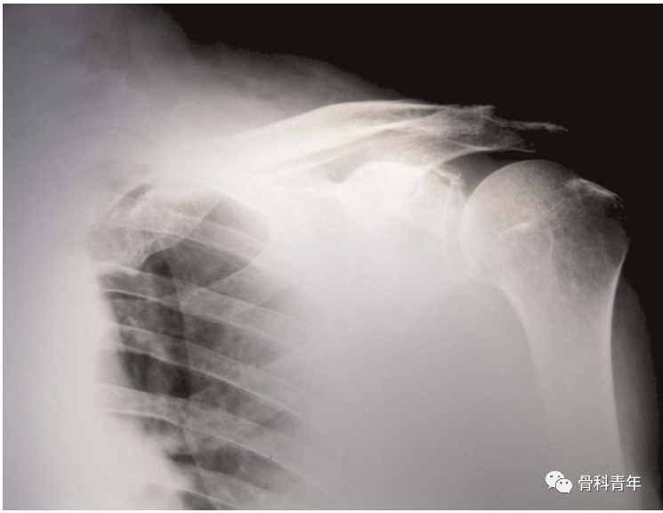 漂浮 锁骨 Floating Clavicle Medsci Cn