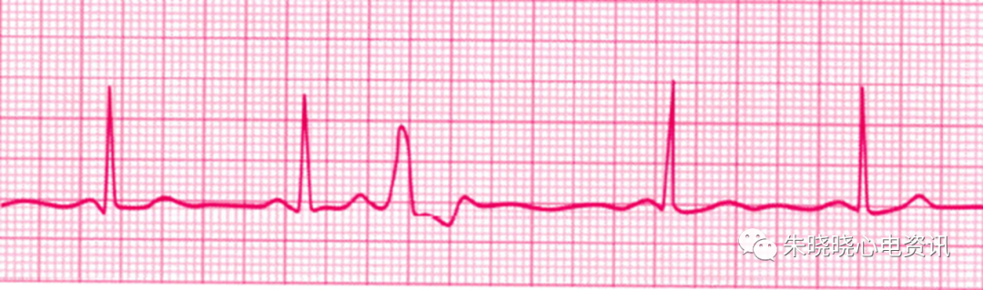 不同早搏的心电图表现与鉴别诊断