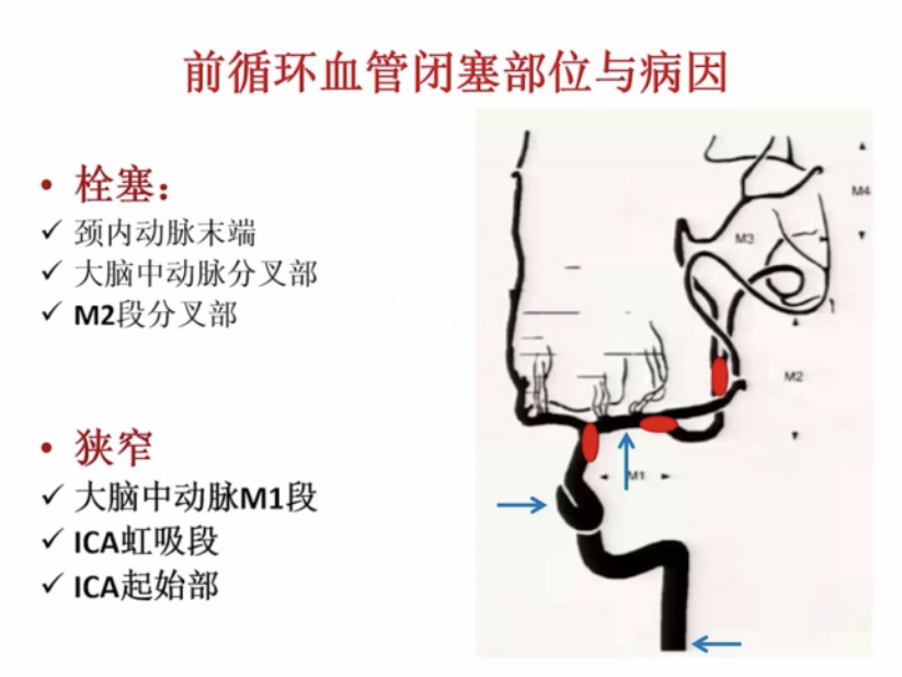 大血管闭塞性卒中病因鉴别 主任经验分享 Medsci Cn