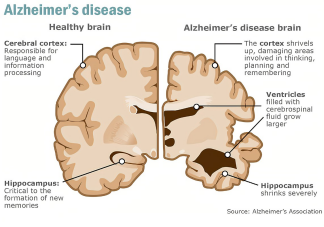 阿尔茨海默病突触紊乱的表观遗传调控