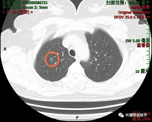 询问分析(2022 . 8 . 7):甲状腺癌手术后发现肺部多发结节 是转移吗？