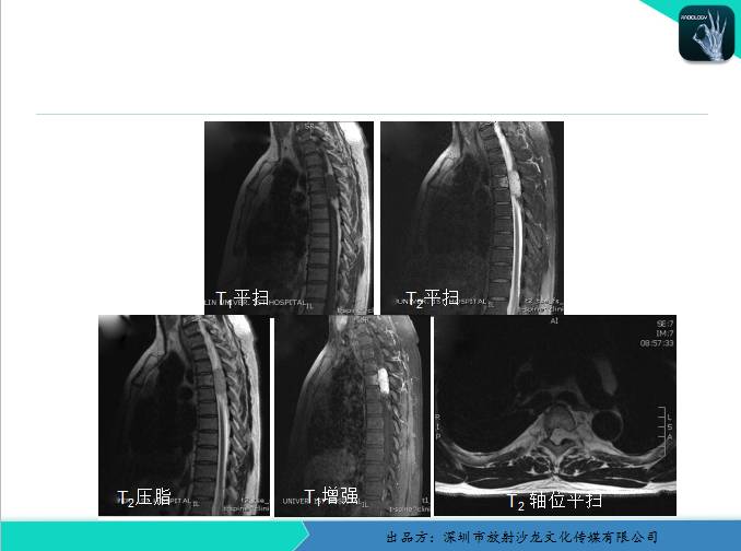 【原创】椎管内血管<font color="red">脂肪瘤</font>