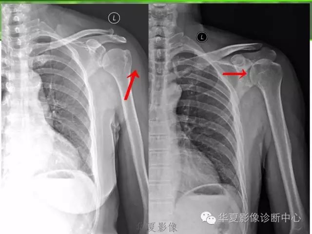 怎么利用X线片看肩周炎？