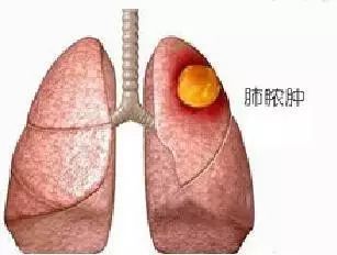 深入学习肺脓肿病例一例