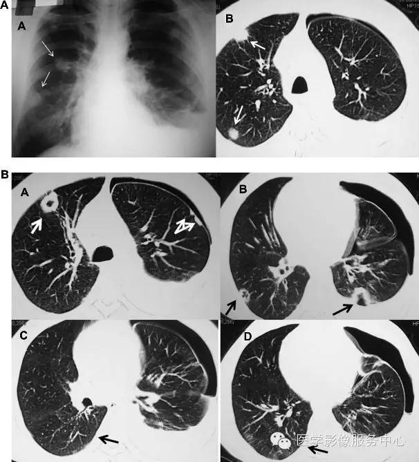 类风湿性关节炎的肺部影像学异常5例