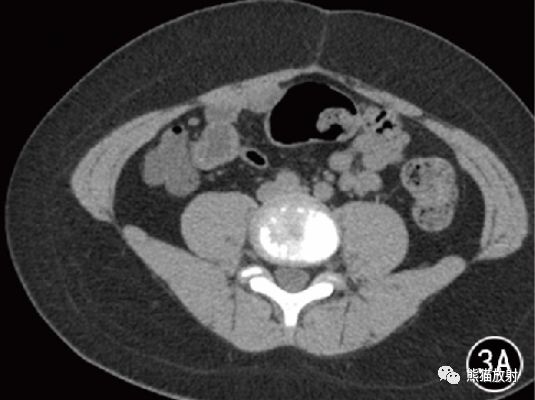 小儿急性阑尾炎丨CT表现及分级