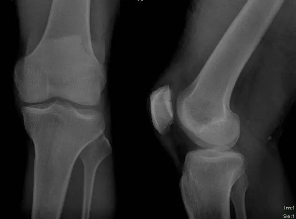 【PHILIPS每日一例】单侧二分髌骨 (Bipartite patella)X线病例图片影像诊断