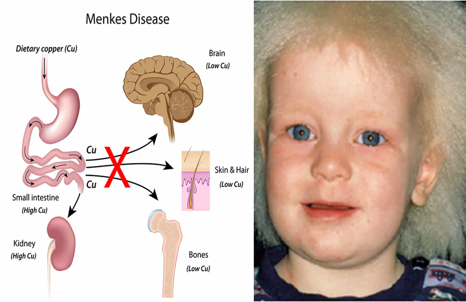Menkes病：症状体征、病因、流行病学、诊断和治疗