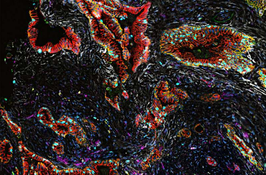 Nat Genet：科学家揭示人类胰腺癌发生及发展的新型分子机制