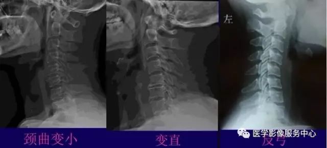 X線片提示頸椎病的五大標(biāo)準(zhǔn)