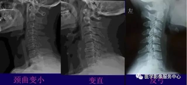 X线片提示颈椎病的五大标准