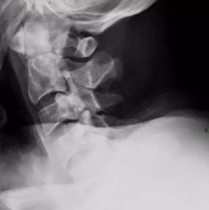 “颈椎病”为什么拍了X线，还要拍CT和MRI？