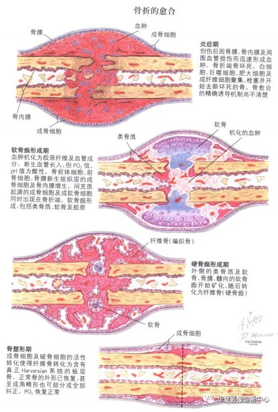 一图带您轻松了解<font color="red">骨折</font><font color="red">愈合</font>