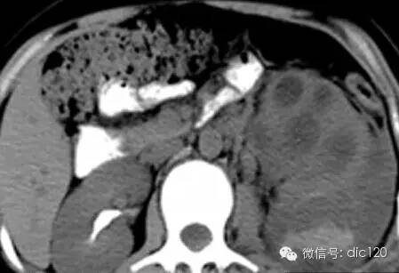 典型病例---左肾黄色肉芽肿性肾盂肾炎CT--影像诊断--分析