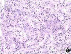肝脏肿瘤误诊病例不典型肝癌（atypical hepatocellular <font color="red">carcinoma</font>）