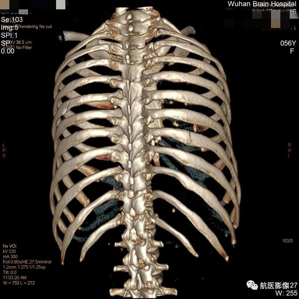 为什么肋骨骨折CT扫描一定要做三维成像