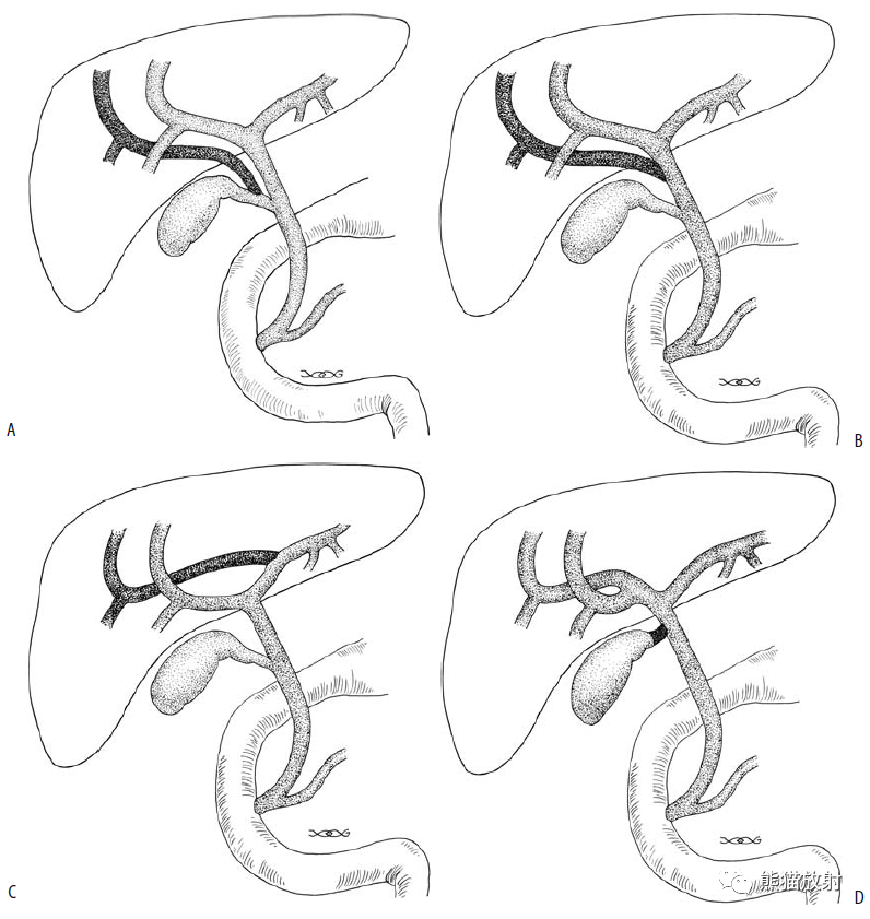 腹部影像图例：胆囊及胆管篇~
