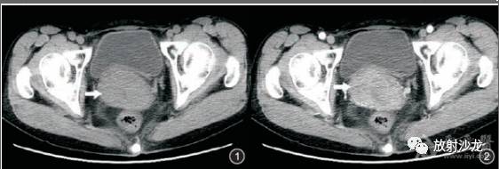 原发性子宫淋巴瘤少见影像表现1例