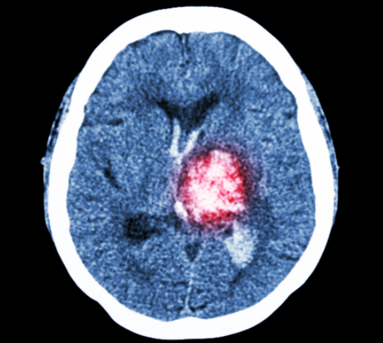 新研究总结降压治疗对脑出血的作用