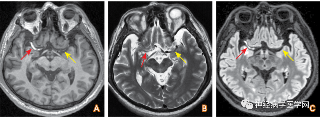 大脑中动脉原位血栓磁共振成像多序列评估与信号解读【图文解析】