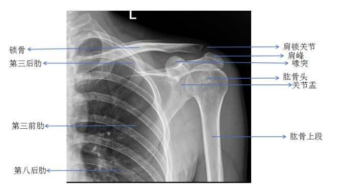 遇到肩部外伤时，有必要做肩关节CT吗？